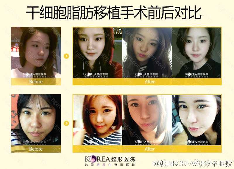 诺华全球创新药Scemblix落地乐城 用于治疗慢性髓性白血病